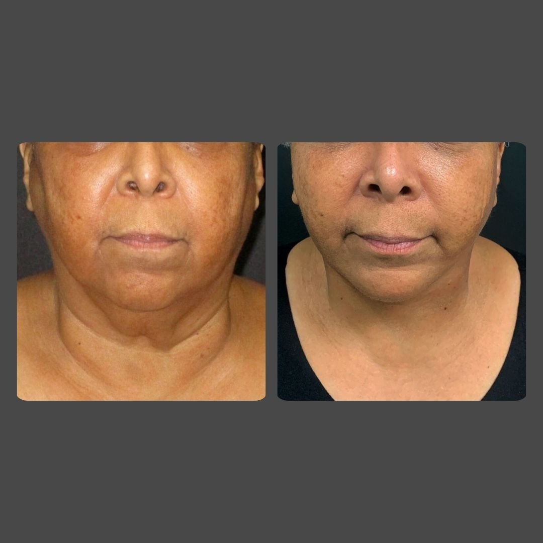 facelift in Weston FL
