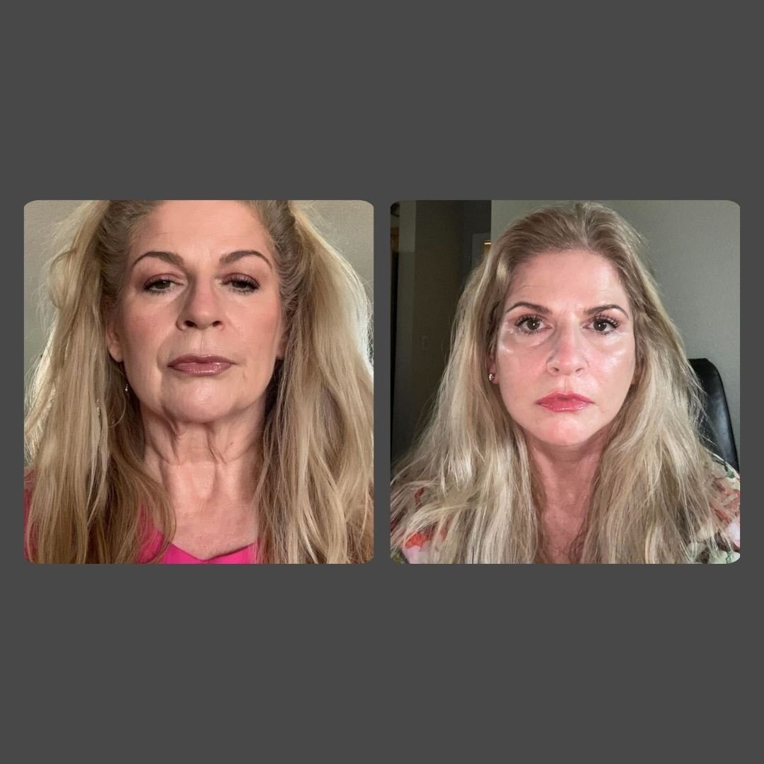 facelift in Weston FL