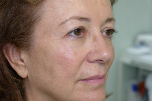 kasv facial mohs repair 1 1780550451274