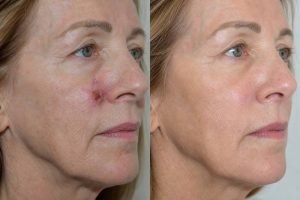 Plastic Surgery Blog Weston FL 4 kasv mohs repair florida 1 1784577805291