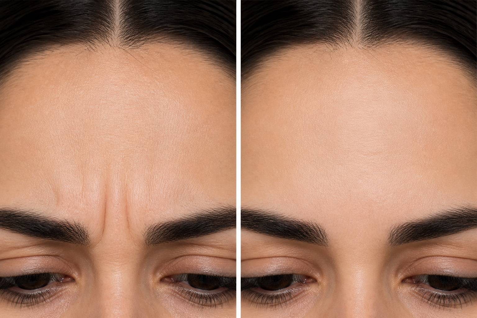 Frown Lines Treatment: 4 Powerful Ways to Smooth Your... 3 Before and after Frown Lines Treatment showing a smoother glabella