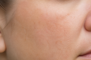 Plastic Surgery Blog Weston FL 8 kasv mohs scar minimization 1 1786511745363