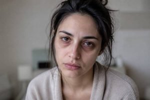 kasv lower blepharoplasty benefits 1 1789146683997
