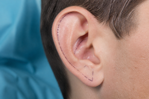 Plastic Surgery Blog Weston FL 1 kasv otoplasty preparation guide 1 1789463785011