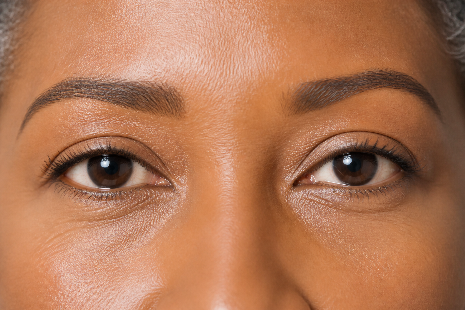 Ptosis Correction Surgery: 4 Ultimate Benefits for Brighter 3 Ptosis correction surgery results showing brighter, alert eyes from The Face Doctor of Florida.