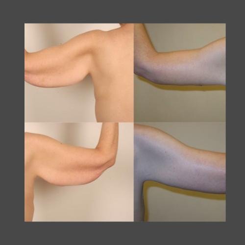 Brachioplasty