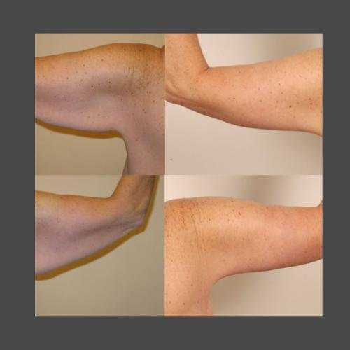 Brachioplasty
