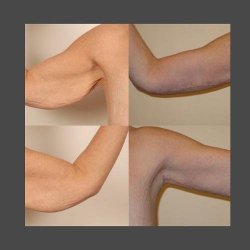 Brachioplasty