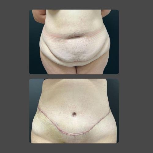Tummy Tuck